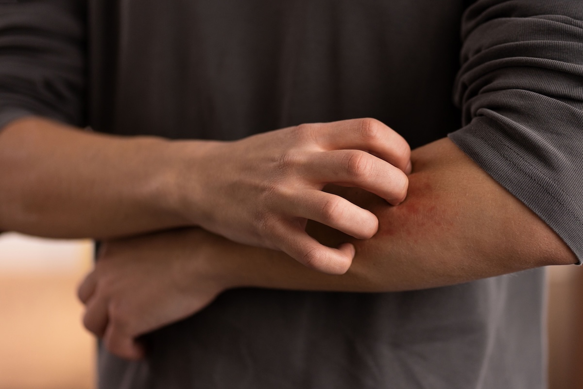 Un homme qui se gratte le bras à cause de lésions provoquées par la leishmaniose.