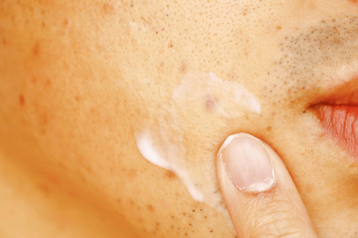Application d'une crème sur les petits boutons et rougeurs autour de la bouche, par suspicion de dermatite périorale.
