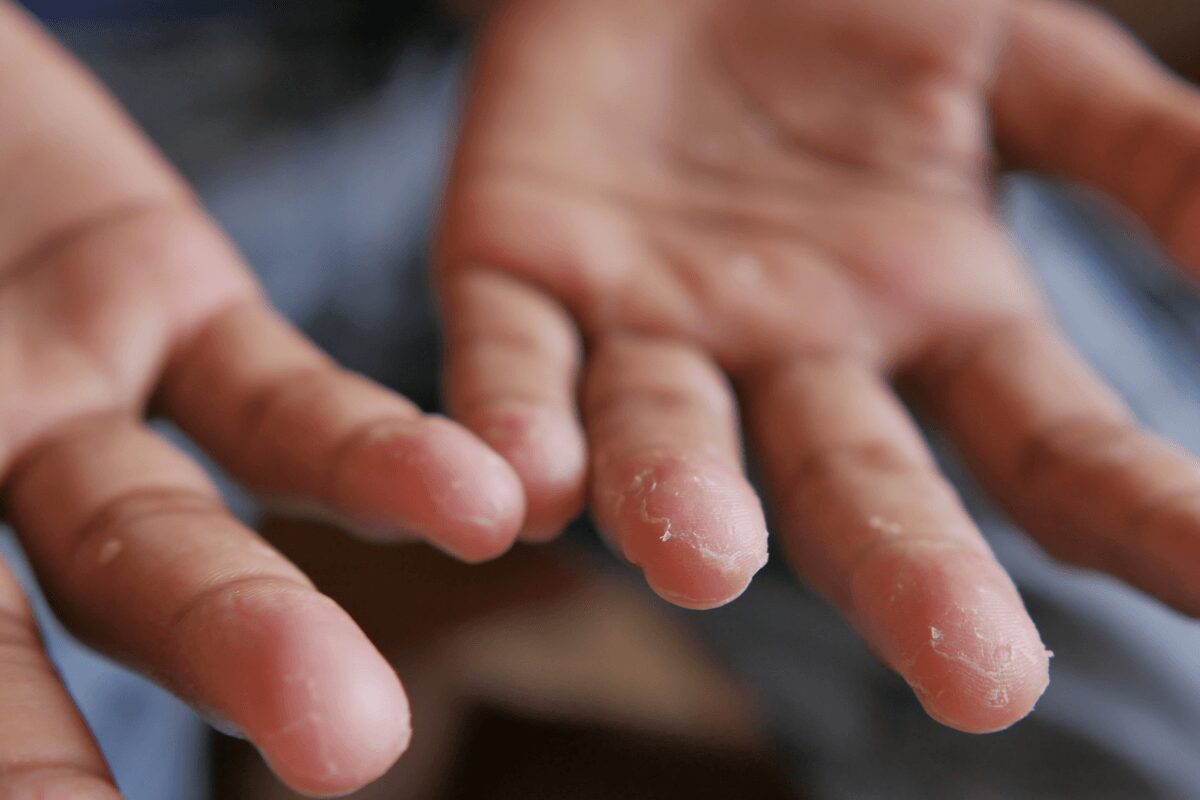 Peau sèche et qui pèle au bout des doigts après l’apparition de petites vésicules de dyshidrose.
