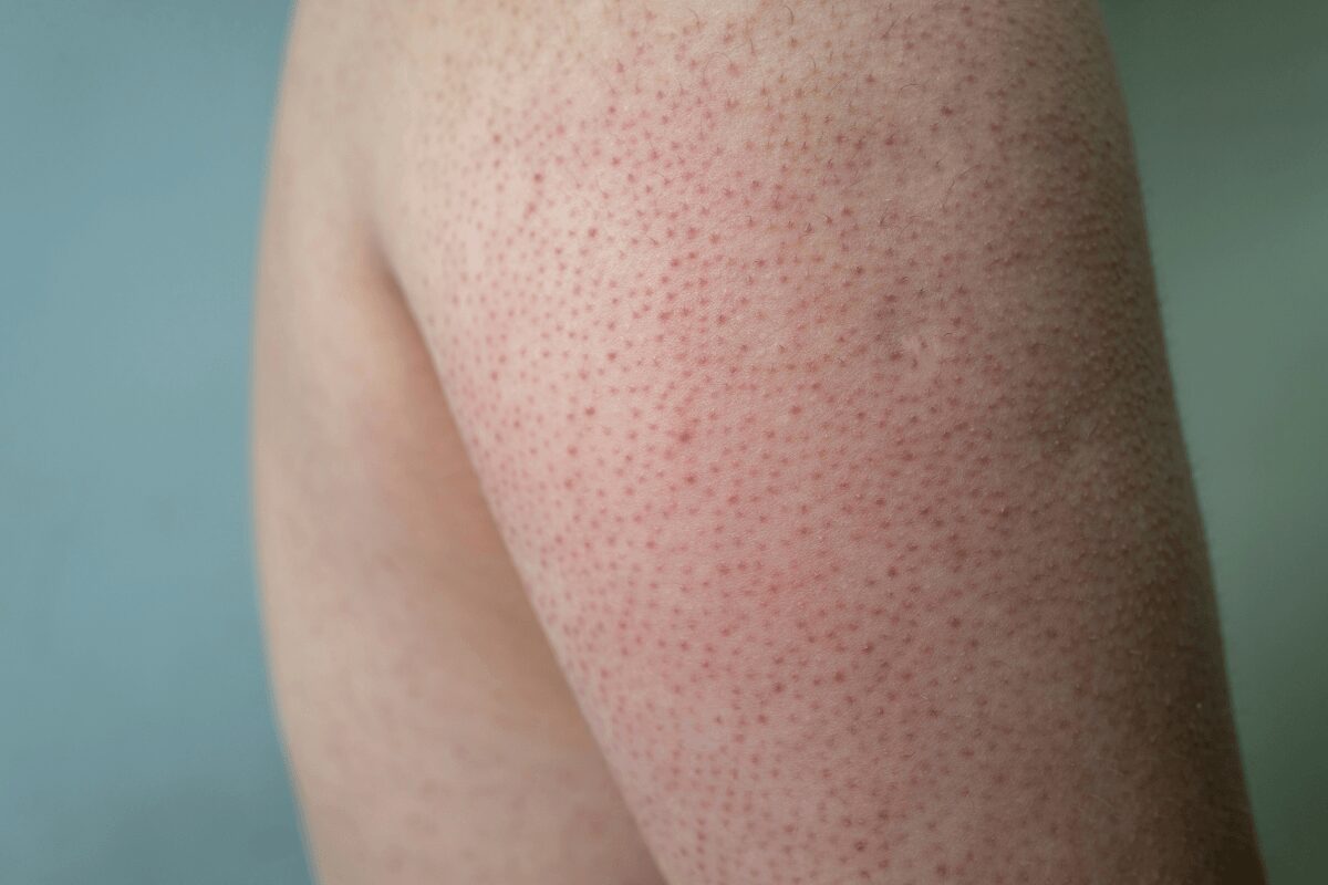 Gros plan sur le un bras d'une personne présentant de nombreux petits boutons rouges, suspectant une kératose pilaire.