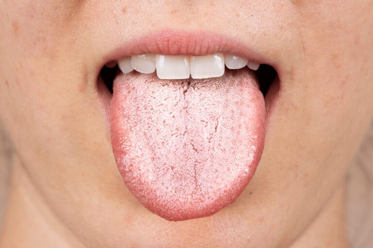 Gros plan sur la langue blanchâtre d’une personne présentant des signes pouvant évoquer une candidose buccale.