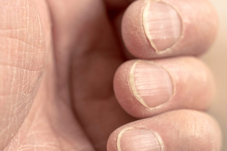 Gros plan sur les ongles d’une personne présentant de fines stries horizontales et une peau sèche autour des doigts.