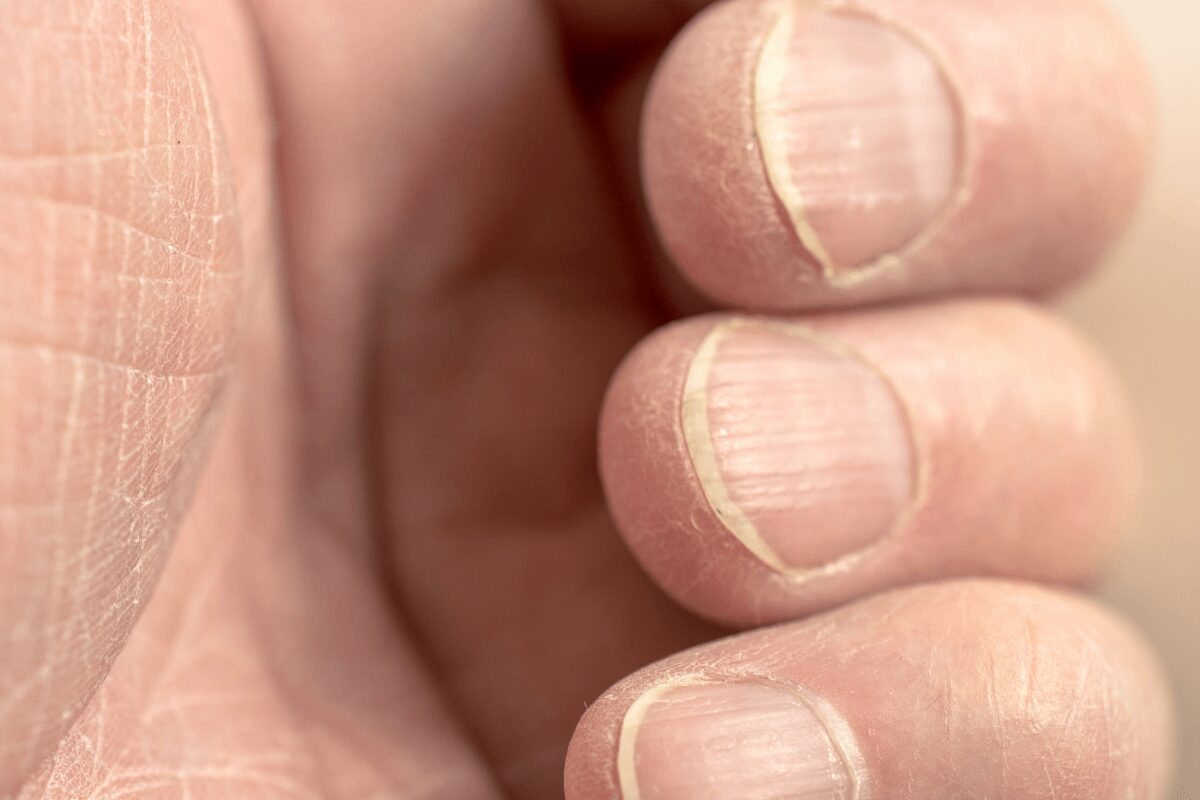 Gros plan sur les ongles d’une personne présentant de fines stries horizontales et une peau sèche autour des doigts.