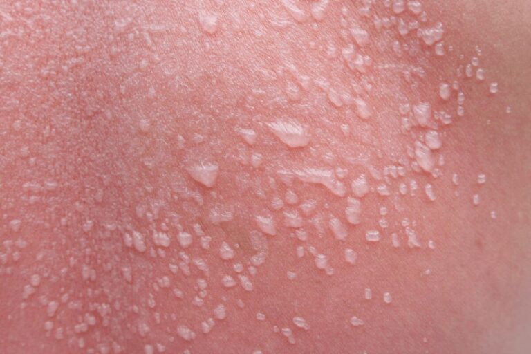 Gros plan sur une peau rouge présentant de nombreuses petites cloques remplies de liquide, suspectant une phytophotodermatose.