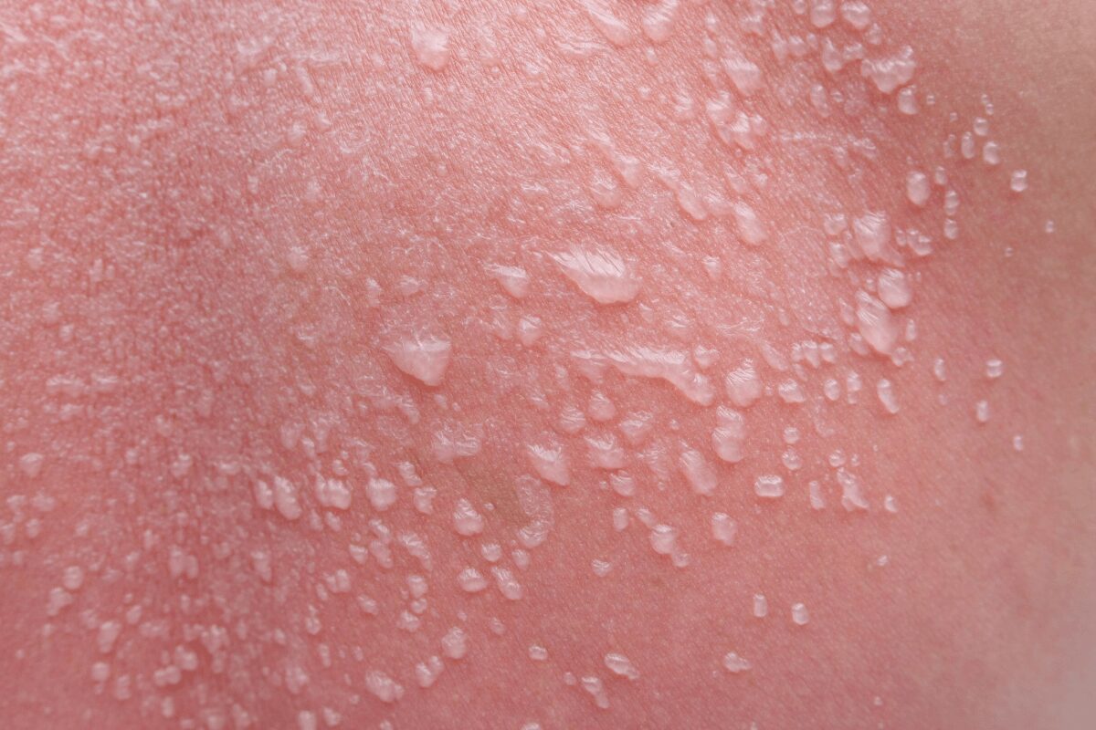 Gros plan sur une peau rouge présentant de nombreuses petites cloques remplies de liquide, suspectant une phytophotodermatose.