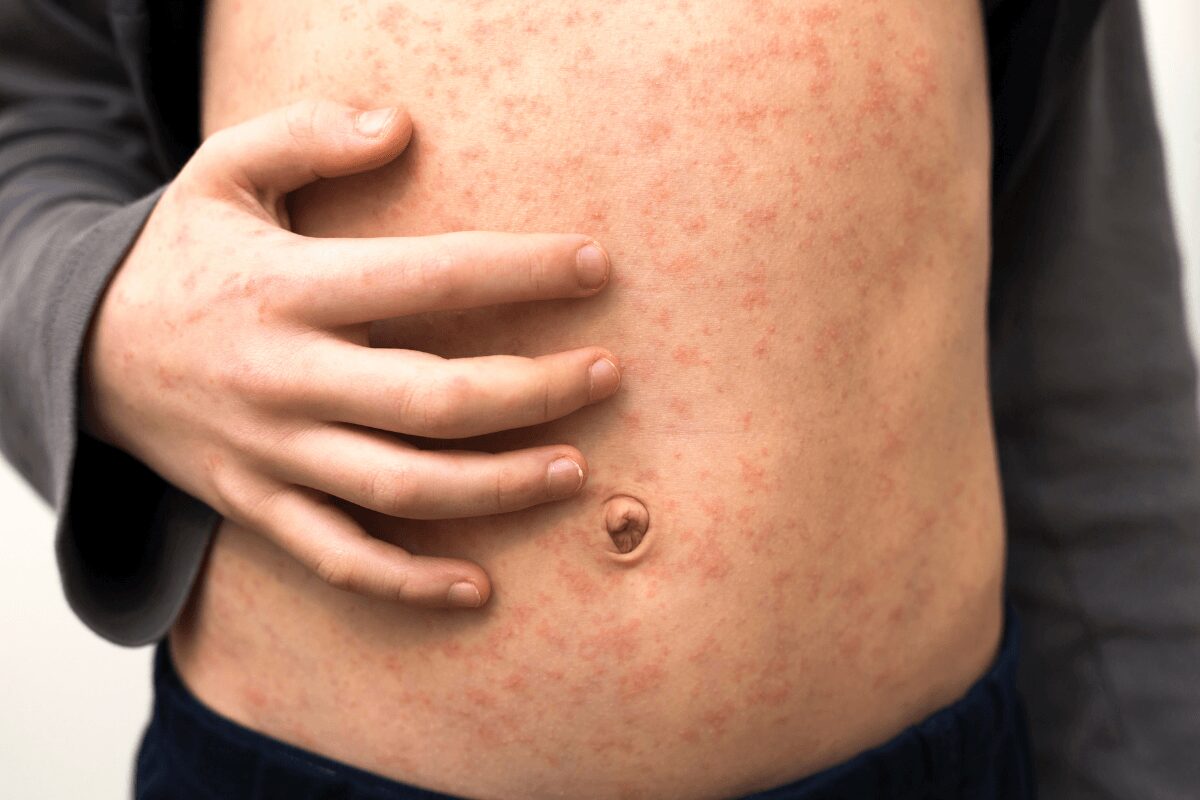 Nombreuses petites plaques rouges visibles sur la peau du ventre d’une personne.