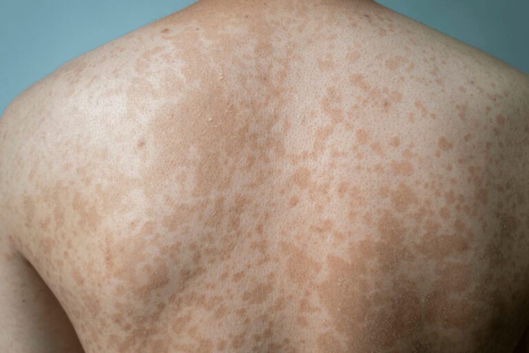 Nombreuses taches brunes et plus claires caractéristiques d’un pityriasis versicolor réparties sur le dos.