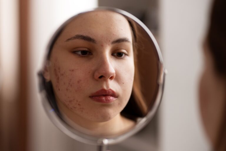 Une jeune femme observe dans le miroir les boutons d’acné apparus sur son visage à la rentrée.