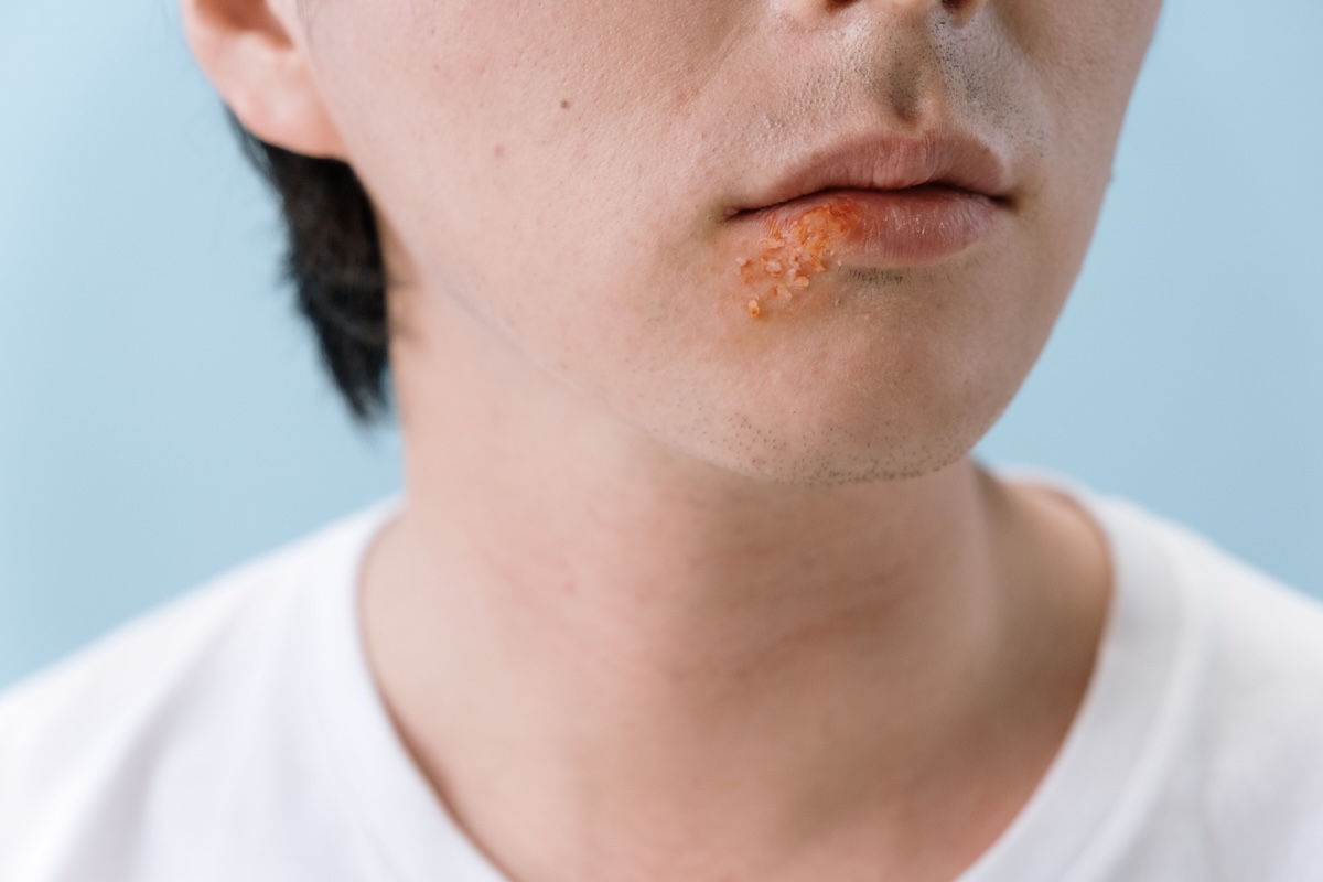 Un gros plan des lèvres d'une personne montrant un impétigo sur la lèvre inférieure.