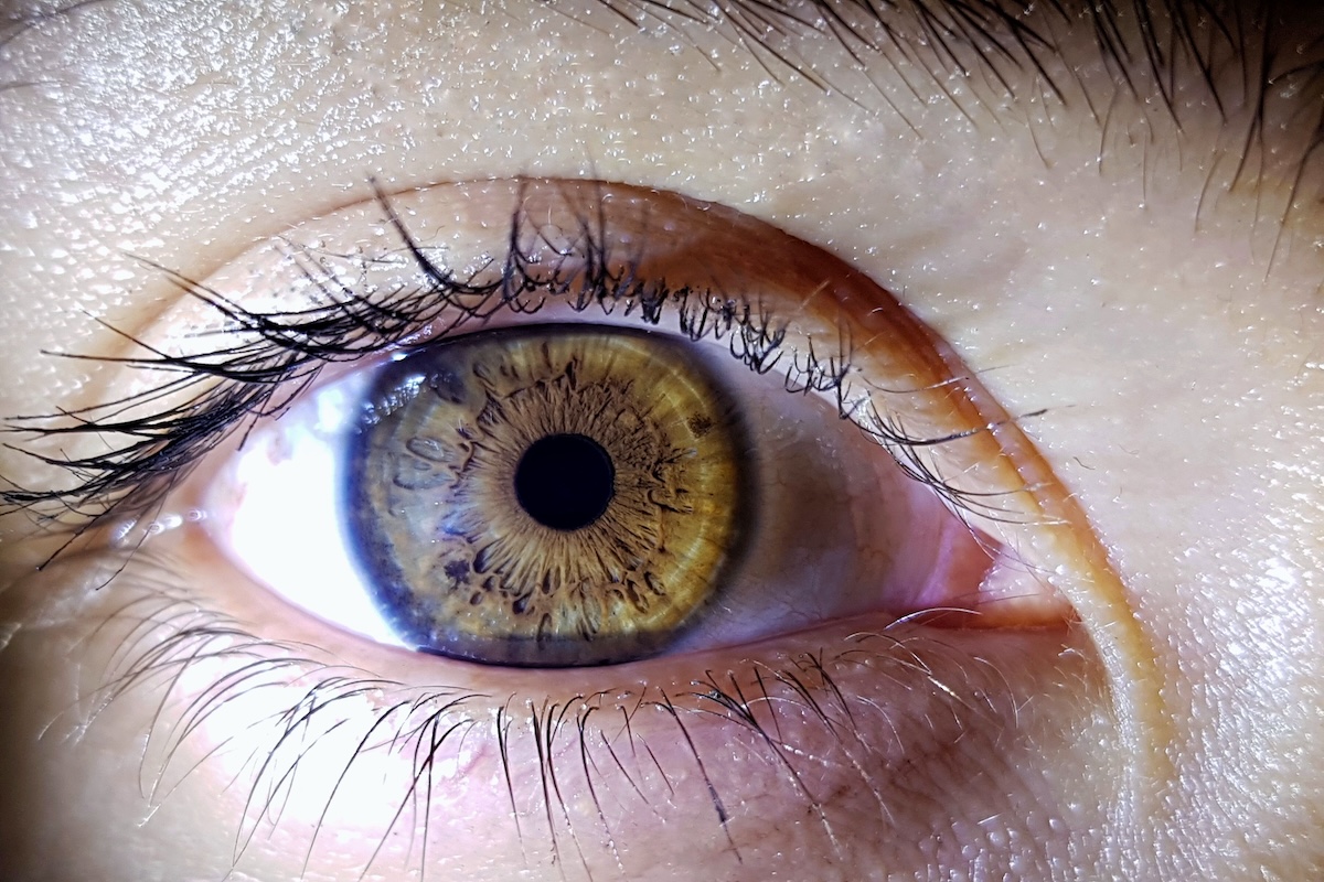 Une femme atteinte d’une kératopathie liée à l’aniridie, qui endommage progressivement la cornée et la vision.