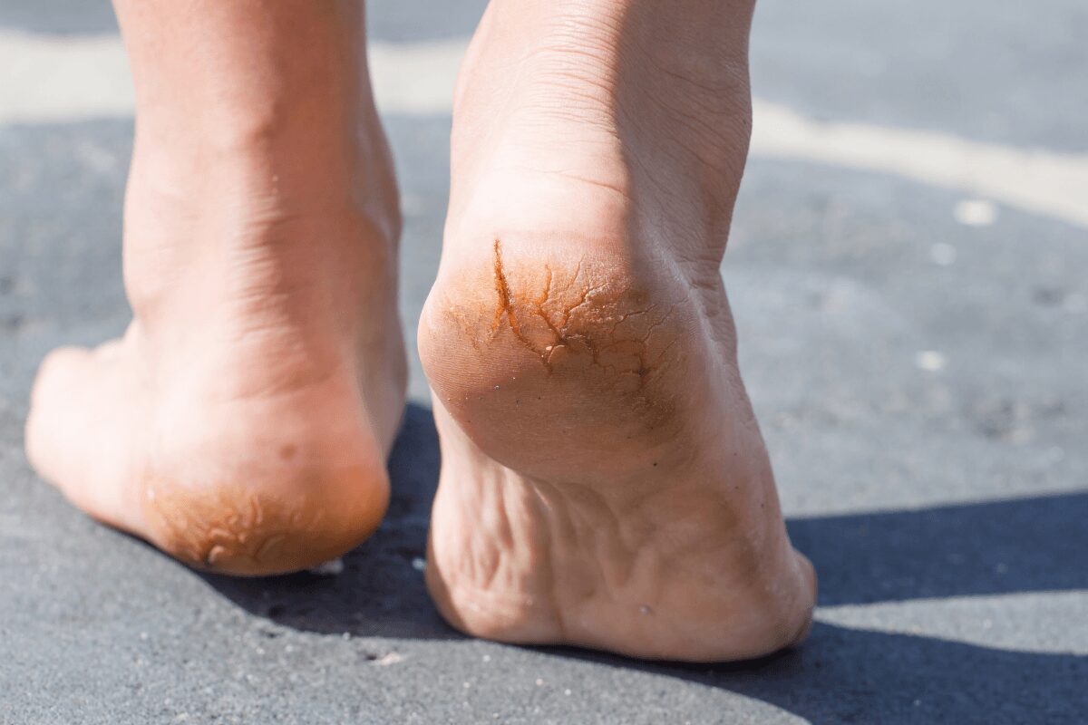 Personne marchant pieds nus avec des talons secs, épaissis et fissurés, les signes d'un xérose cutanée.