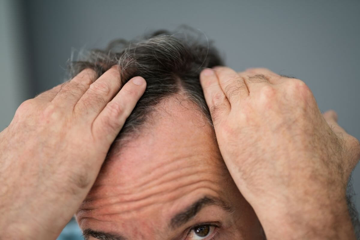 Gros plan sur un homme écartant ses cheveux avec ses mains et laissant apparaître son cuir chevelu au niveau des golfes.