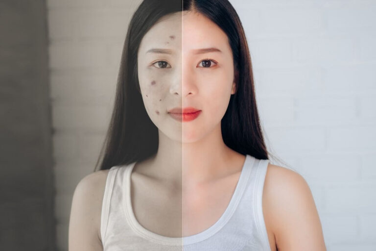 Portrait comparatif d’une femme présentant une moitié du visage plus foncée et des taches cutanées, suspectant une maladie d’Addison.